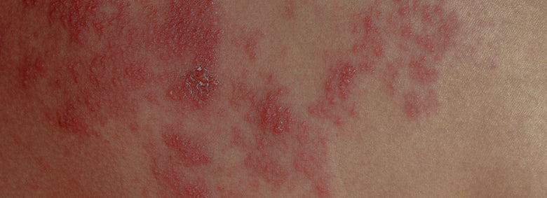 04---Blog---Dermatite-01