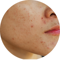 Acne